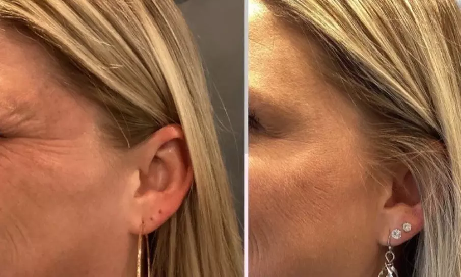 Revitalize with 60 Units of Dysport or Lip Flip Dysport Injections