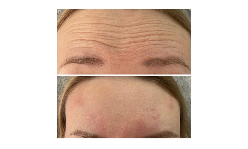 Image 4: 20, 40, or 60 Units of Botox And Filler for Rejuvenating Your Skin 