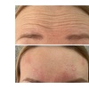 Image 4: 20, 40, or 60 Units of Botox And Filler for Rejuvenating Your Skin 