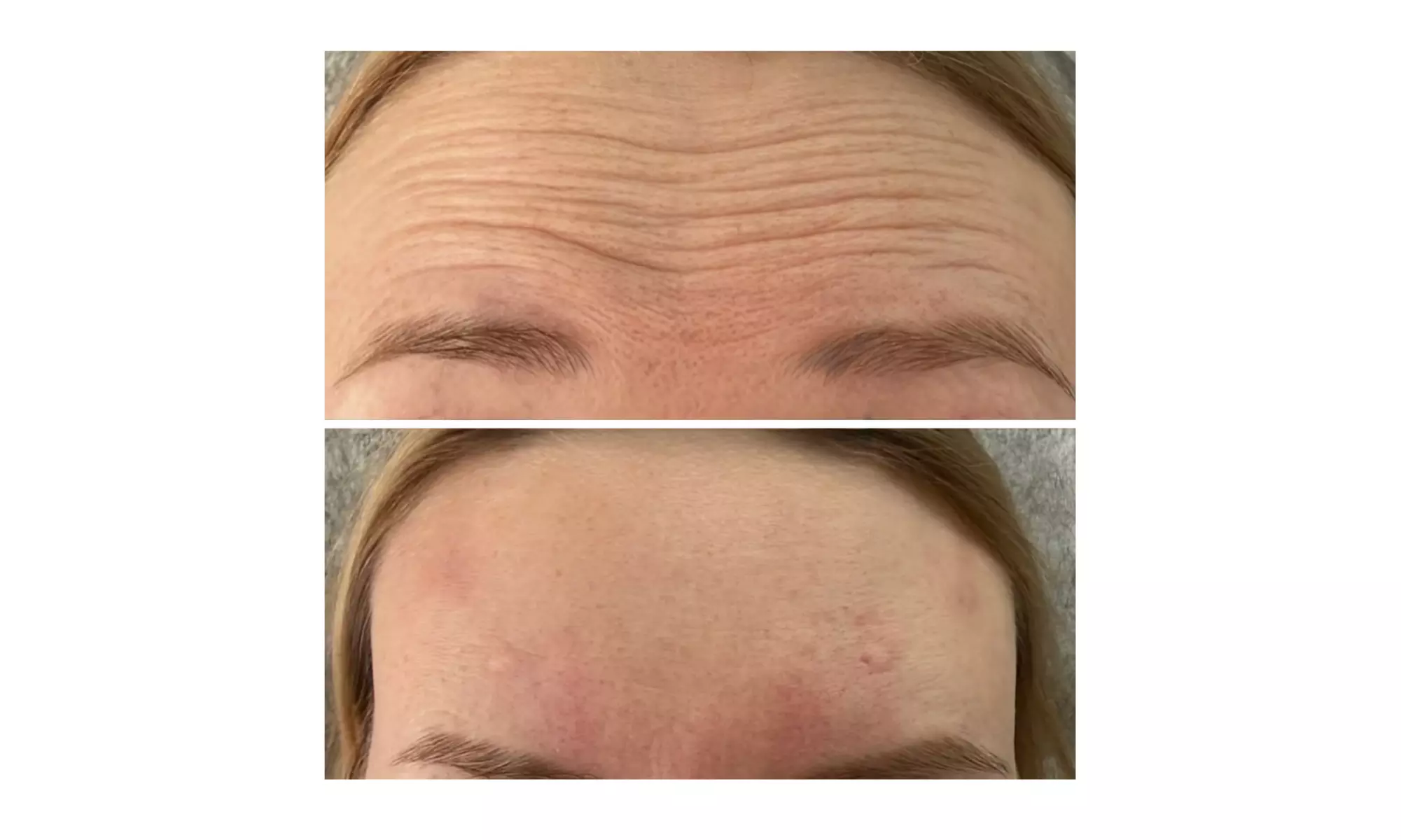 The Ageless Look: Premium Botox® and Filler Bundles At AK Medical Spa