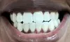 Revitalize Your Smile with One or Two Sessions of 90-Min Professional In Office Teeth Whitening (Up To 52% Off)