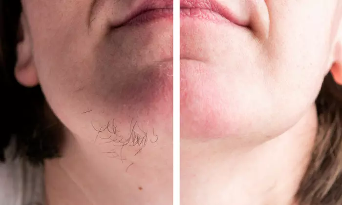 Six Laser Hair-Removal Treatments on a S, M & More Areas 91%