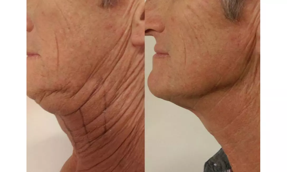 Non-Invasive HIFU Treatments for Crow's Feet, Chin & More