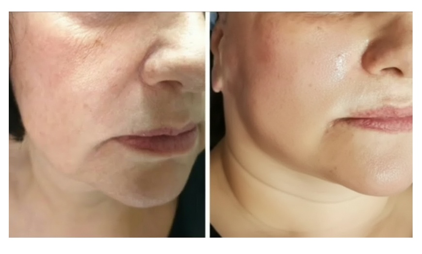 Image 4: Non-Invasive HIFU Face Neck or Intimate HIFU Skin Tightening