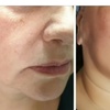 Image 4: Non-Invasive HIFU Face Neck or Intimate HIFU Skin Tightening