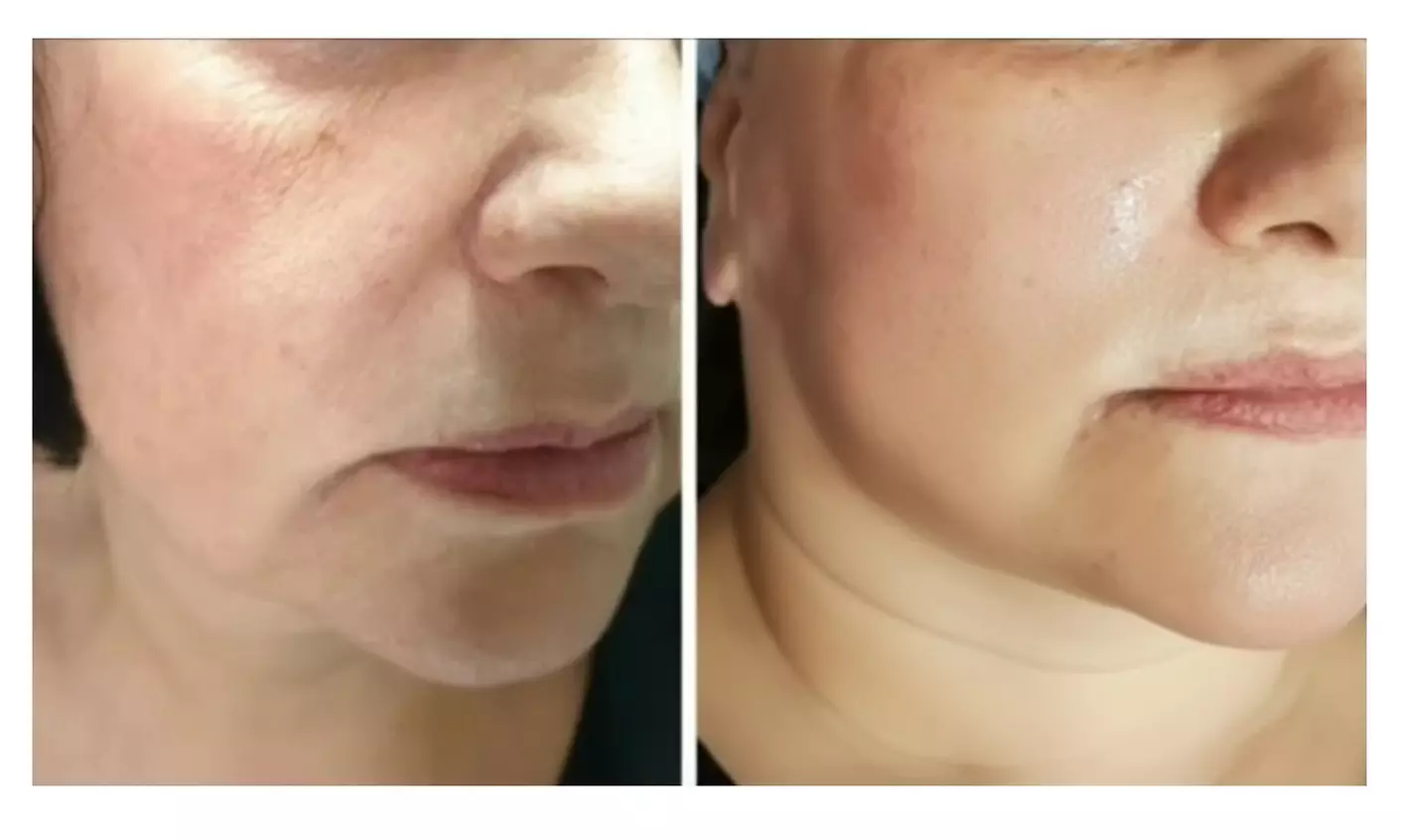 Experience HIFU Face Neck or Intimate HIFU Tightening Treatments at 4evayung Beauty (Up To 47% Off) - Image 4