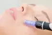 1 oder 2 Microneedling- oder Aqua-Facial-Behandlungen à 60 Min. für 1 Person (bis zu 59% sparen) - Second Medium