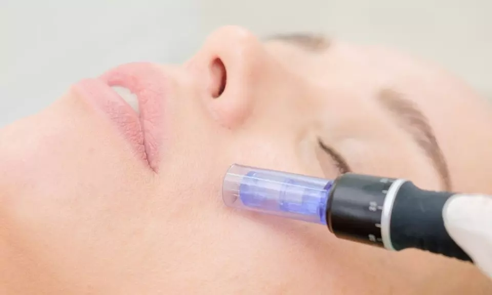 1 oder 2 Microneedling- oder Aqua-Facial-Behandlungen für 1 Person