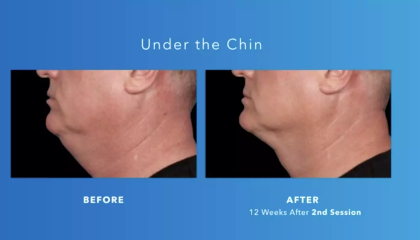 Complete 5-Month CoolSculpting Program Treatments for One at Elite Skin Studio's  - Up to 55% Off - Second Medium