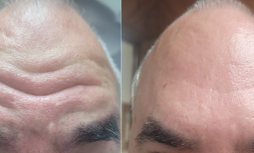 Image 2: Get Refreshed with 20, or 40 Units of Xeomin Injections 