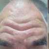 Image 2: Get Refreshed with 20, or 40 Units of Xeomin Injections 
