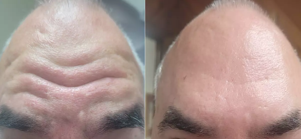Get Refreshed with 20, or 40 Units of Xeomin Injections