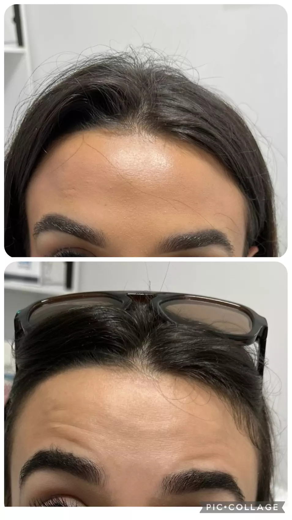 Enhance Your Skin with 20, 40 or 60 Units of Botox