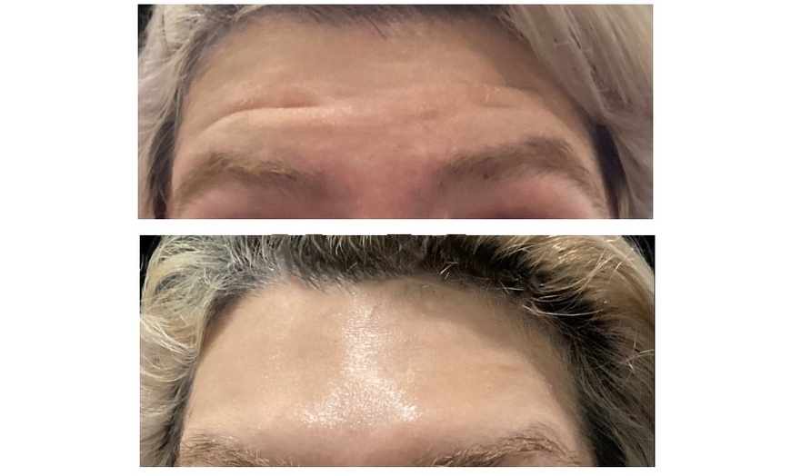 Image 3: Refresh Your Look with 20 or 40 Units of Xeomin