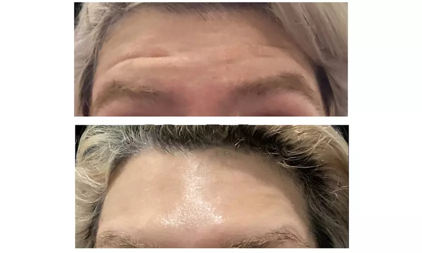 Refresh Your Look with 20 or 40 Units of Xeomin