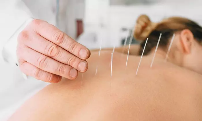 Restaura la armonía en tu cuerpo con 6 o 12 sesiones de acupuntura