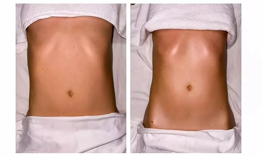 One, Two or Three Cryo-Slimming Session for 1 Person (20 minutes)
