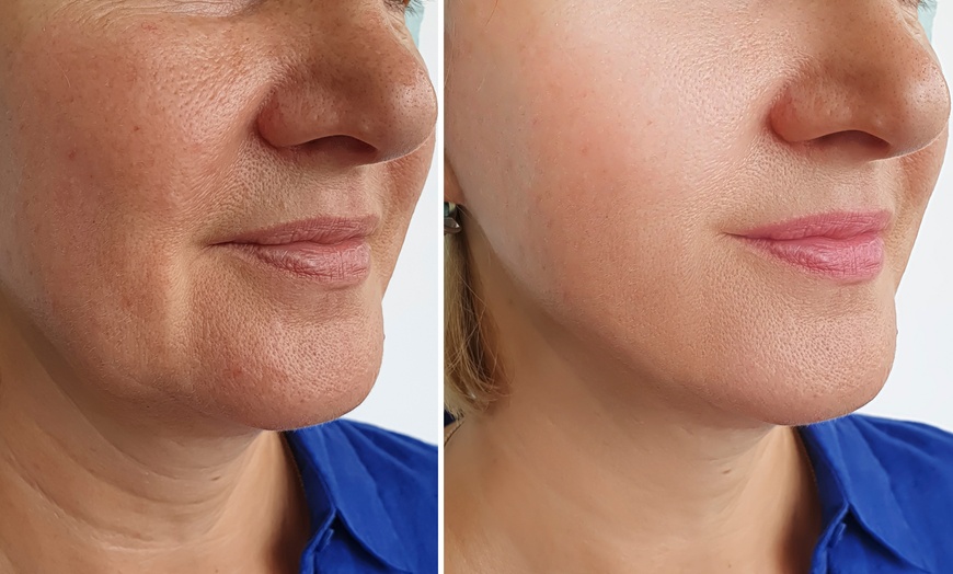 Image 1: Lift Your Look with One Non-Surgical Face or Neck PDO Threads