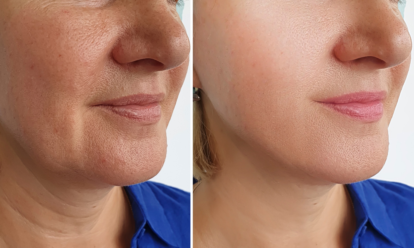 Lift Your Look with One Non-Surgical Face or Neck PDO Threads