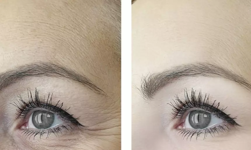 29% Off Botox + Juvederm at Studio Donna Med Spa