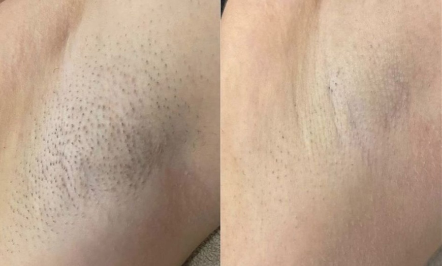 Image 2: Get 6 Laser Hair Removal Sessions on Any Area with Skinology Lab