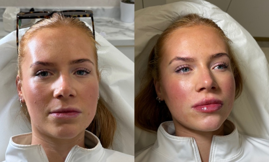 Image 2: Up to 60% Off on Injection - Dermal Filler at Morgan Taylor Beauty Lounge