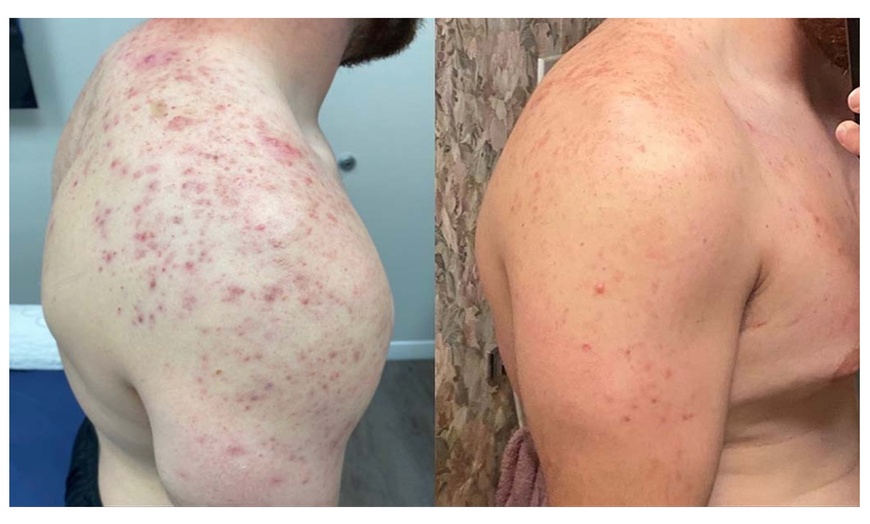 Image 8: Choose Medical Dermalux MD Triwave LED Light Therapy Pak of 10 or 20 