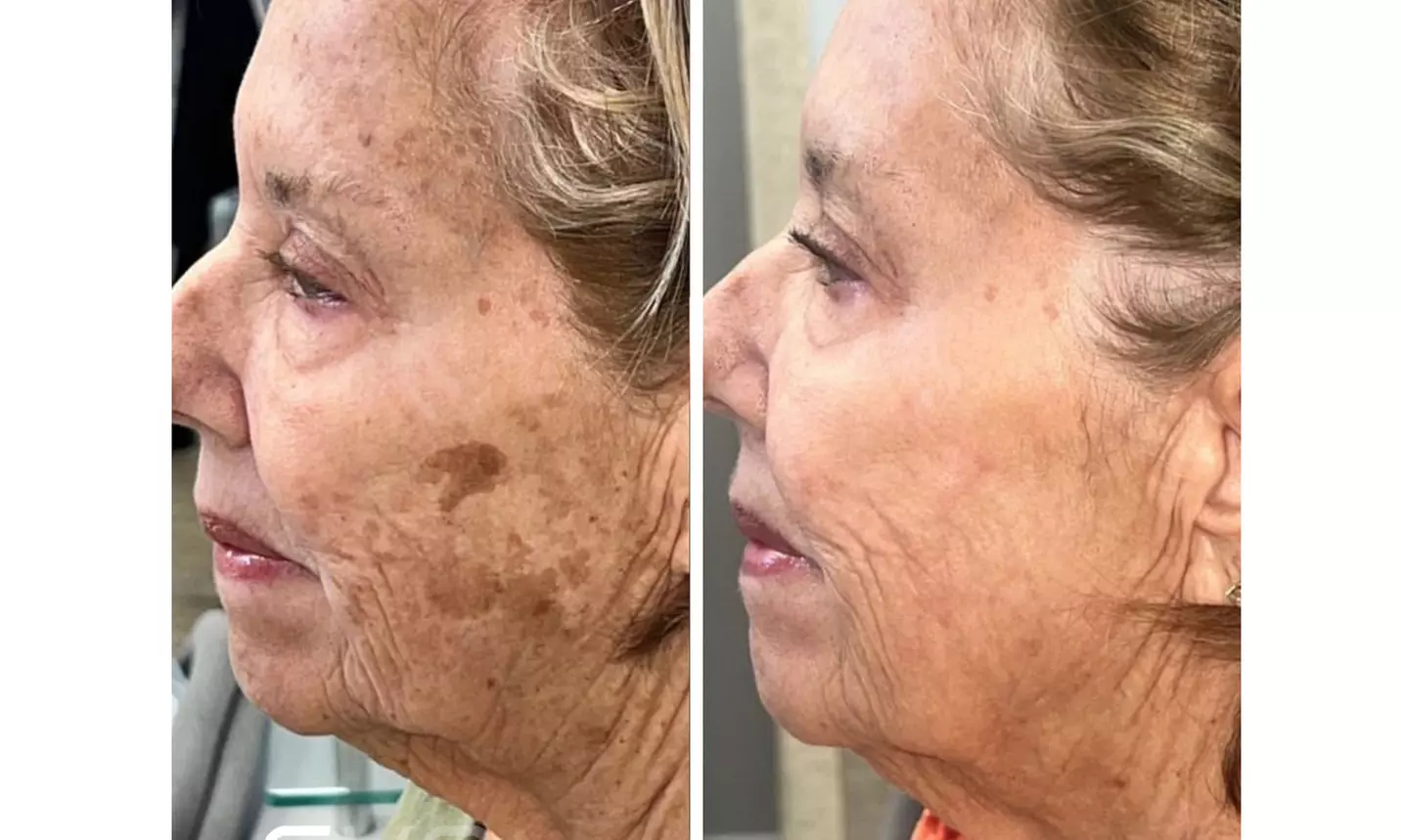 CoolPeel CO2 Laser Treatment for Full Face / Hands