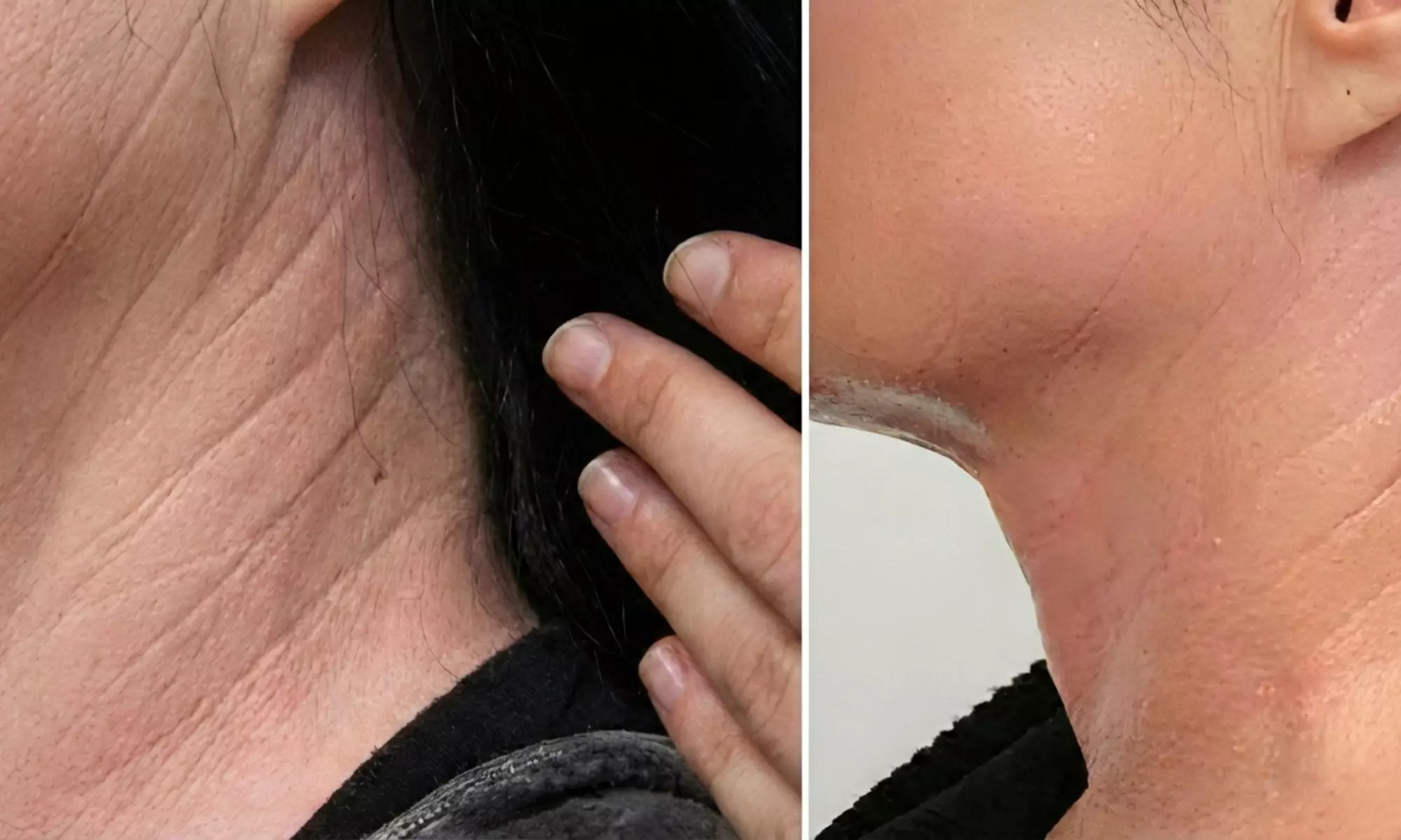 VelaShape Sessions for Targeted Body Contouring & Cellulite Reduction