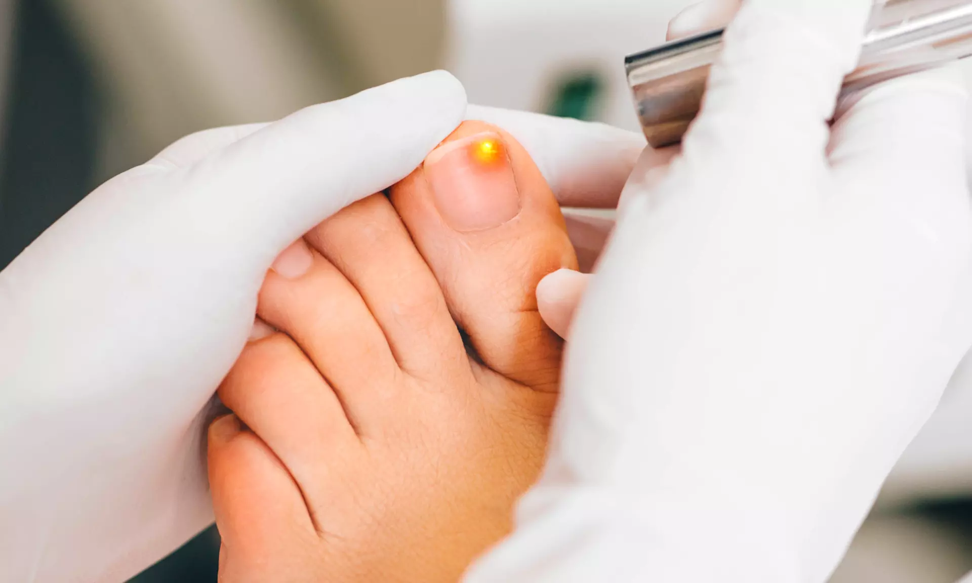 Restore Healthy Nails with Advanced Laser Toe Fungus Treatment for Hands or Feet (Up to 27% Off) - Primary Image