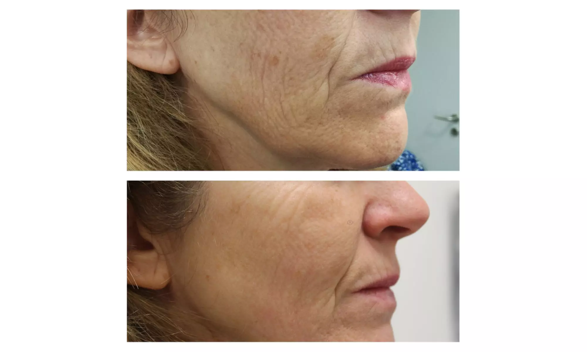 Plasma-Pen zur Augenlidstraffung oder Behandlung von Pigmentflecken