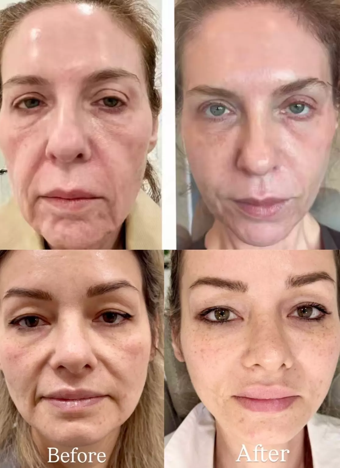 Botox Treatments @ Holistic Beauty Clinic by Alia (Up to 50%)