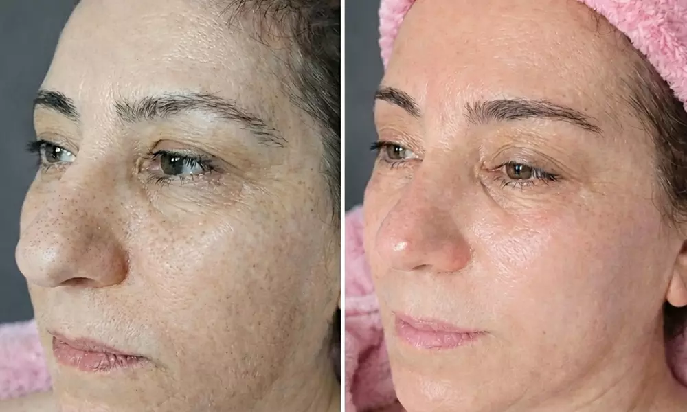 Refresh Your Skin with One/Two HydraFacial