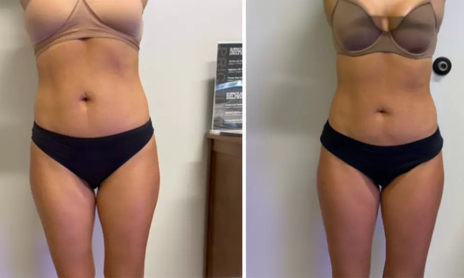 Sculpt, Tone, And Glow with 30,45,60,or 90-Min Sculpting Sessions