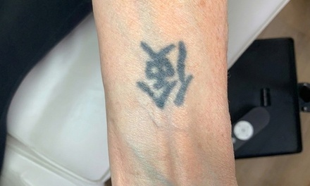 Three Laser Tattoo Removal Sessions on a Small Area - Naked Lasers