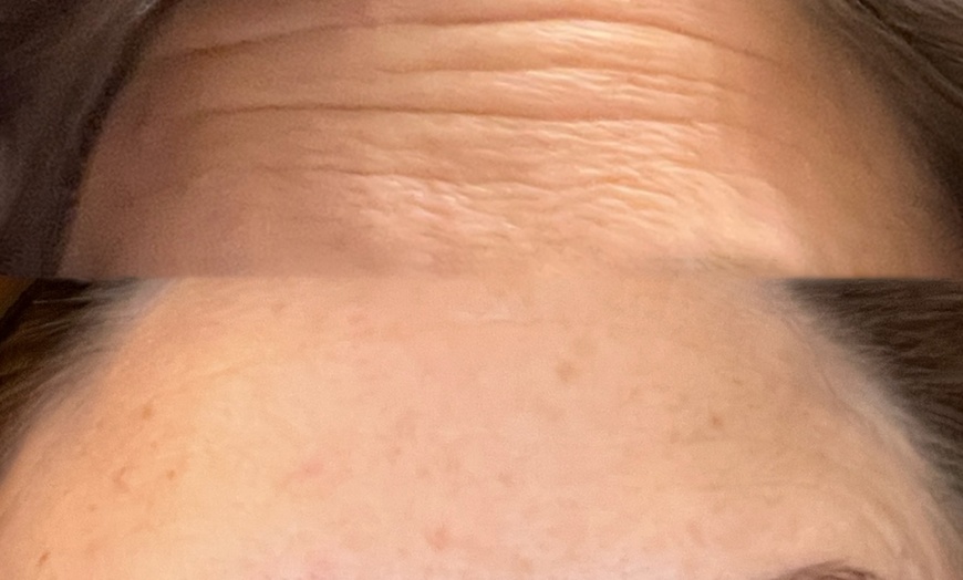 Image 4: Get a Youthful Glow with 20, 40, or 60 Units of Daxxify