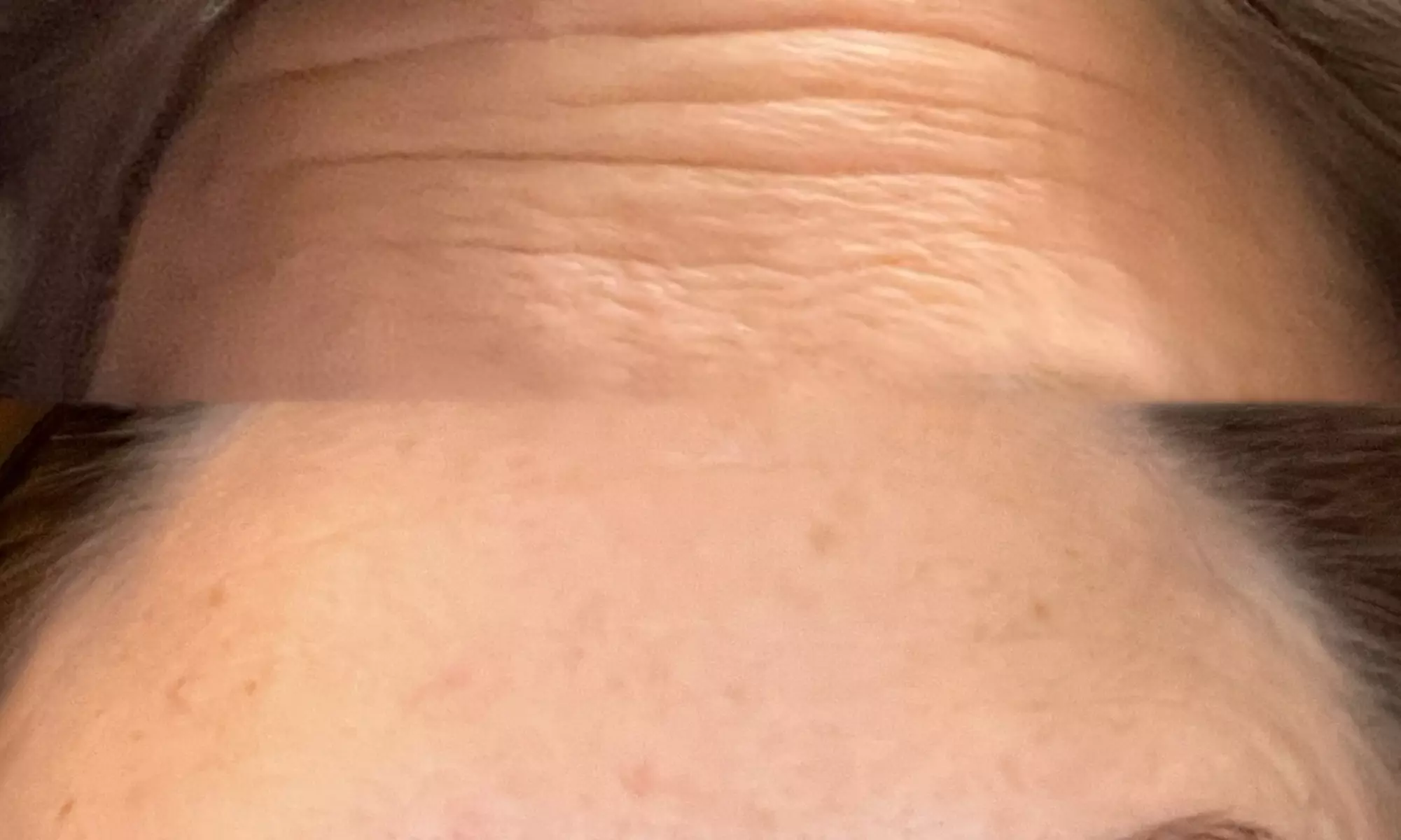 Get a Youthful Glow with 20, 40, or 60 Units of Daxxify