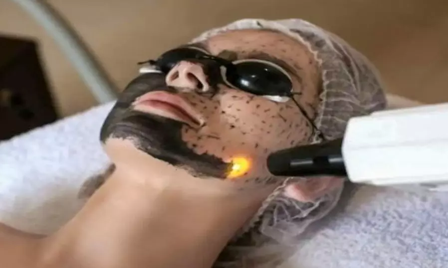 Ervaar een diepe gelaatsverzorging met carbonpeeling: 1 óf 3 sessies