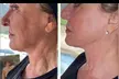 (Up to 70% Off) Transform your skin with One or Two 60-Minute Jet Plasma Treatments at Doll Haus Aesthetics - Second Medium
