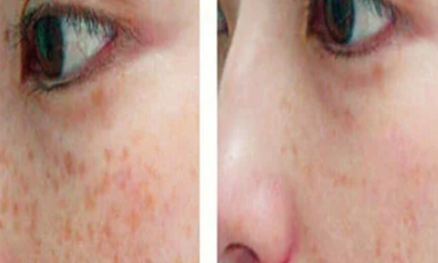 Image 4: Facial Rejuvenation w/Photobiodynamic Treatment: Target Wrinkle & More