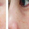 Image 4: Facial Rejuvenation w/Photobiodynamic Treatment: Target Wrinkle & More