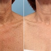 Image 3: Lumenis IPL Laser Skin Resurfacing Treatment for Face & Optional Neck