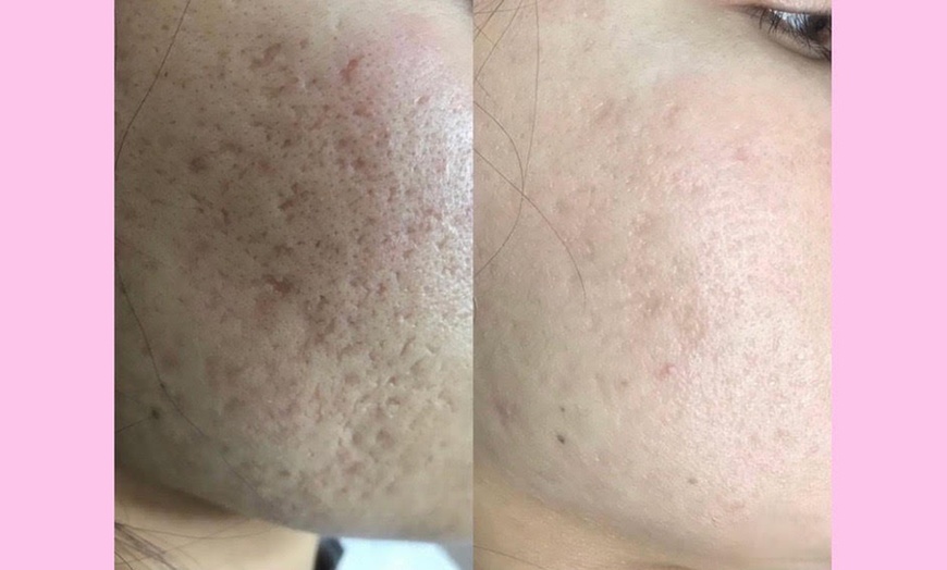 Image 1:  Radiant Silk-Skin Timeless Beauty Rejuvenation Microneedling & Scar Removal Treatment