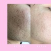 Image 1:  Radiant Silk-Skin Timeless Beauty Rejuvenation Microneedling & Scar Removal Treatment