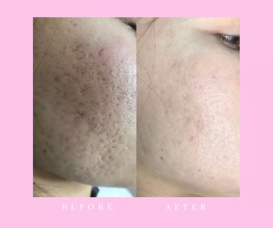  Radiant Silk-Skin Timeless Beauty Rejuvenation Microneedling & Scar Removal Treatment