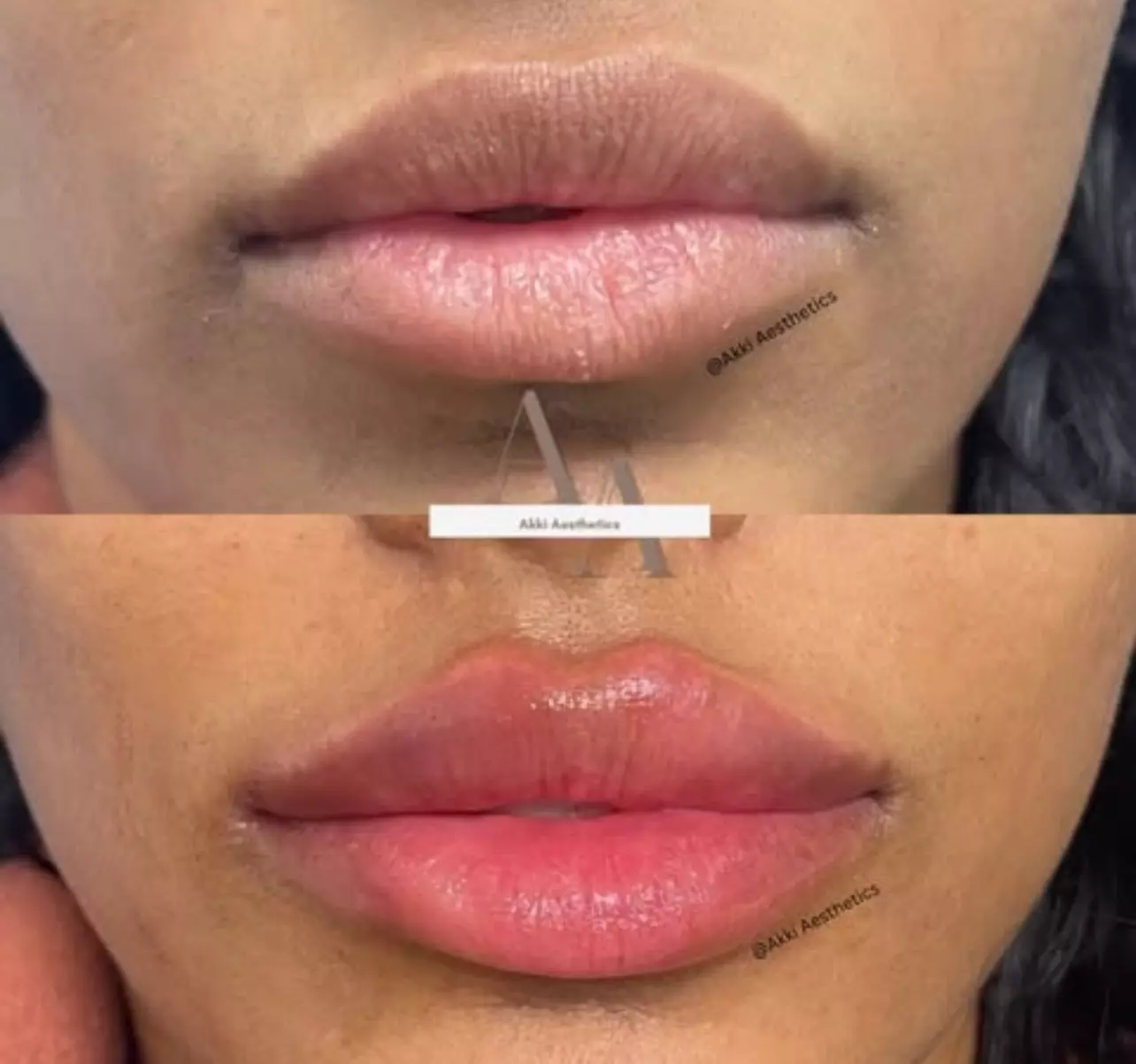 The Ageless Look: Premium Botox® and Filler Bundles At AK Medical Spa (Up to 64% Off) - Second Medium