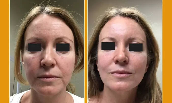 Ultherapy Prime Treatment with options for Face, Neck and Chest