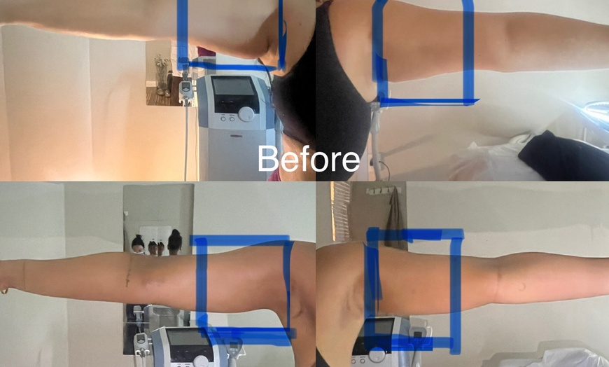 Image 6: Up to 70% Off on Ultrasonic Fat Reduction