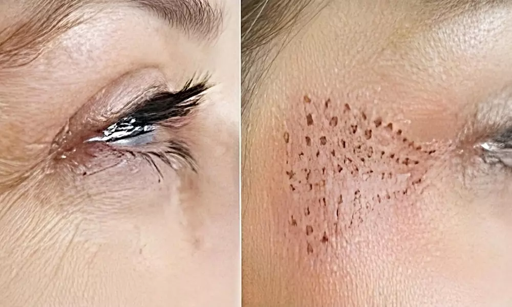 1 o 2 sesiones de plasma pen en zona a elegir para 1 persona