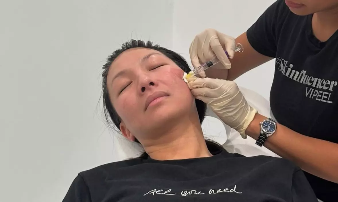 Revitalize with One or Two Vials of Sculptra